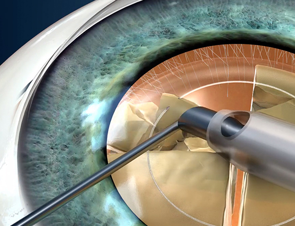 image of cataract eye