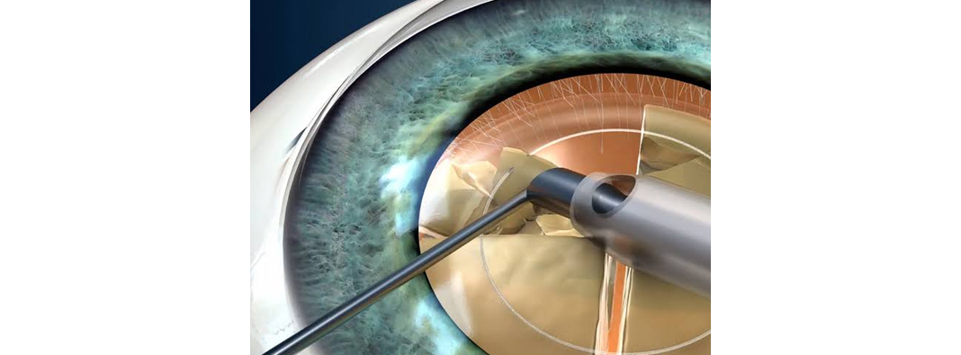 Cataract Surgery|Eye Specialist in Jabalpur |Daksh Netralaya