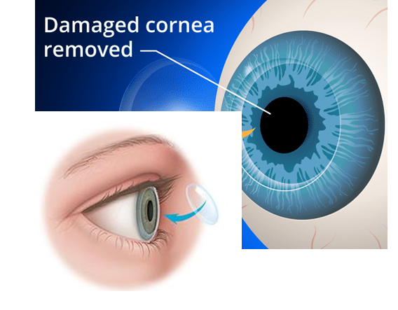 image of corneal removel