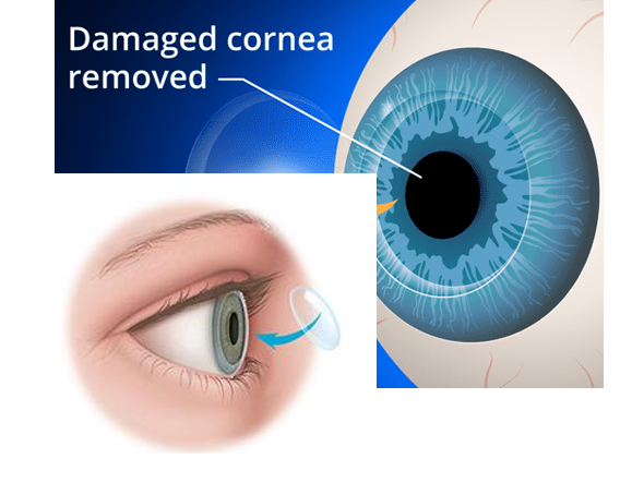 image of corneal removel image of corneal removel