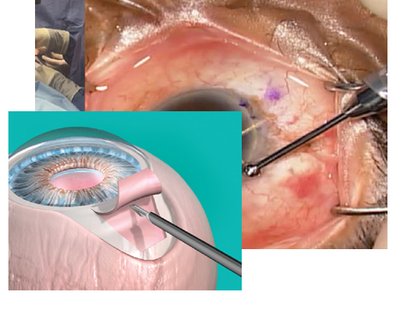 glaucoma Treating Image Eye