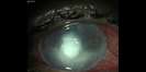image of cornea eye