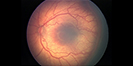 image of retinopathy