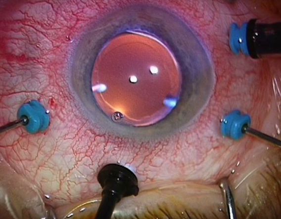 vitreo Treating Image Eye vitreo Treating Image Eye