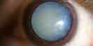 image of eye cataract