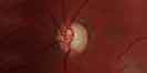 image of glaucoma